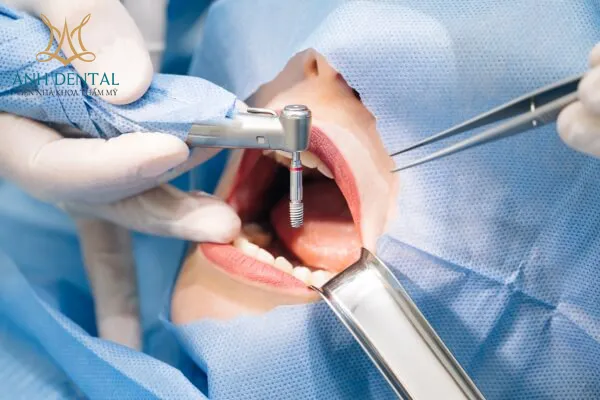 Ghép xương tự thân có đau không
