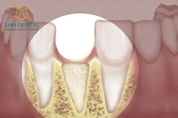 Ghép xương tự thân có đau không