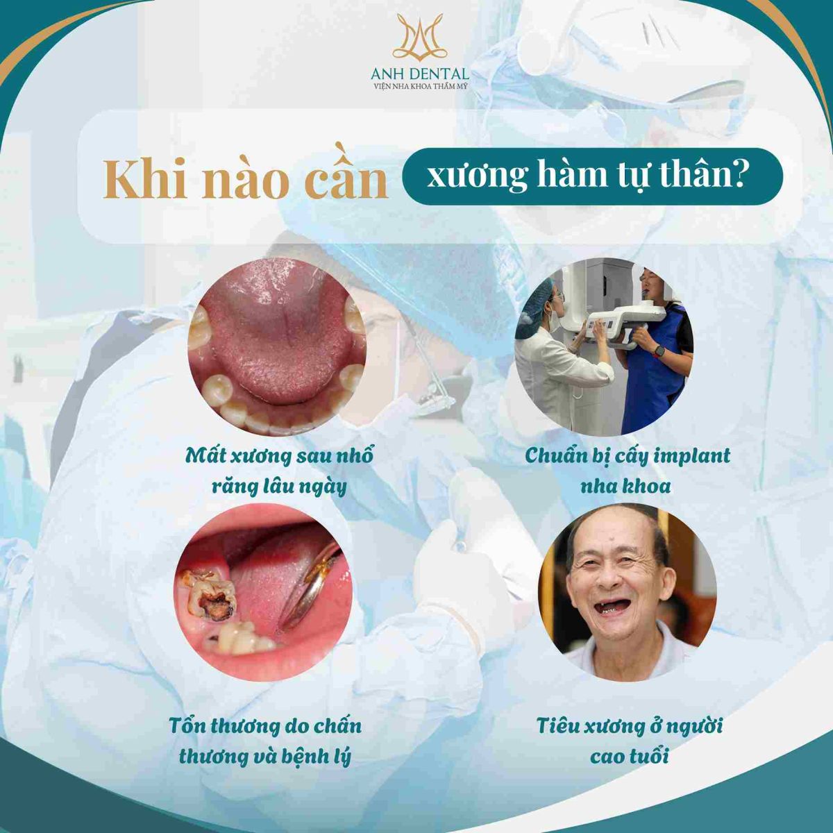 ghép xương hàm tự thân là gì
