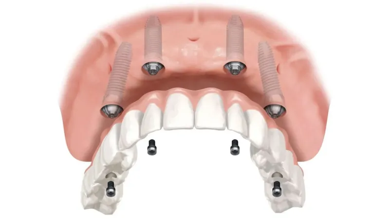 implant all-on-4 giá rẻ