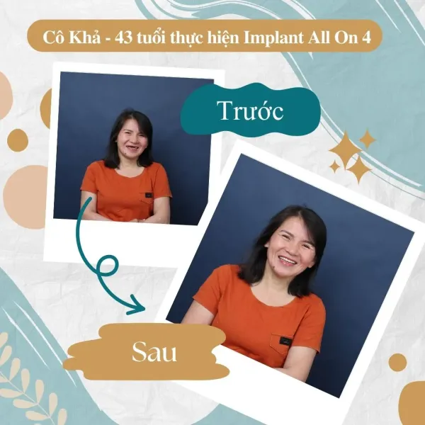 implant all-on-4 giá rẻ