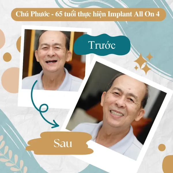 implant all-on-4 giá rẻ