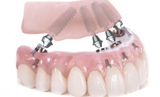 implant all-on-4 giá rẻ