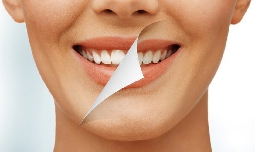 tẩy trắng răng xong bị vàng lại