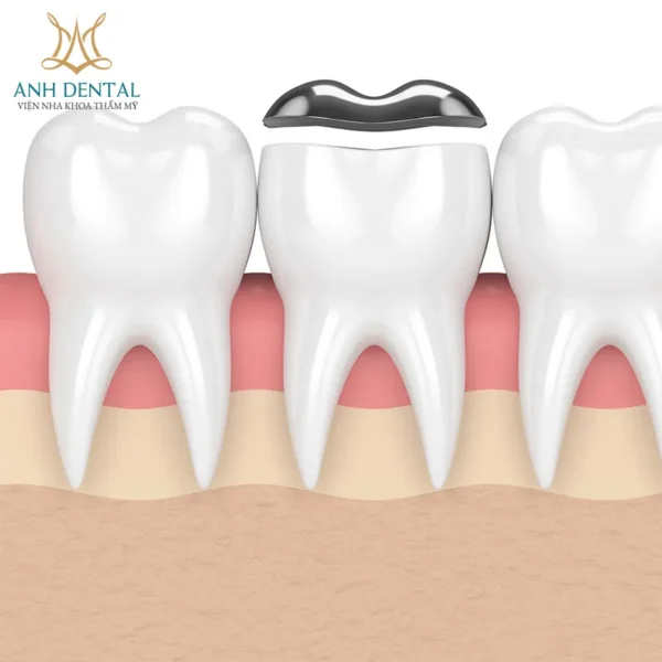 trám răng inlay onlay