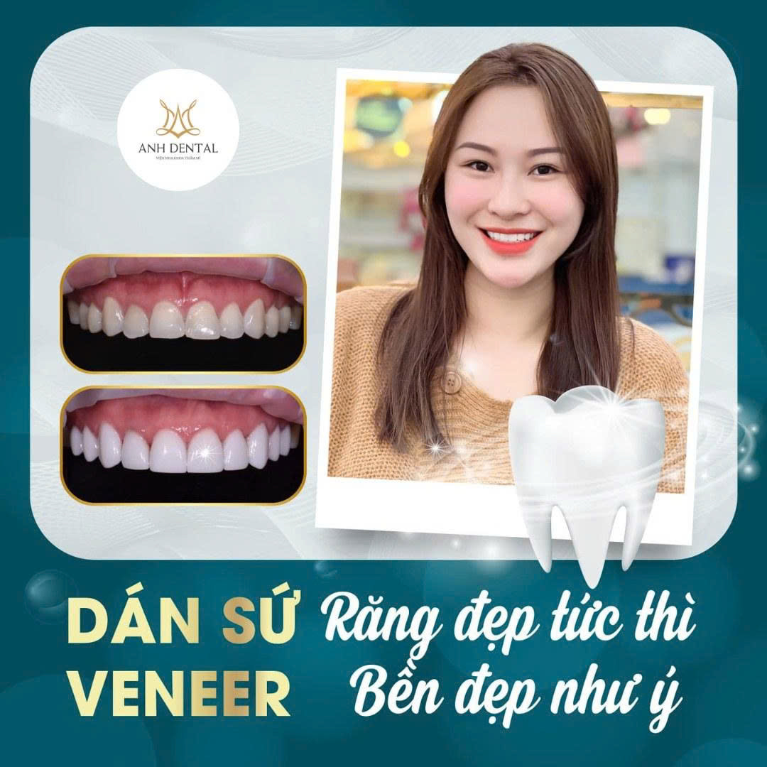 dán sứ veneer