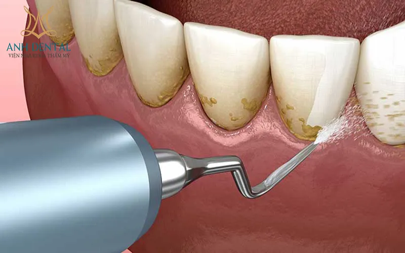 Cạo vôi răng là cách thức chăm sóc và điều trị răng miệng hiệu quả
