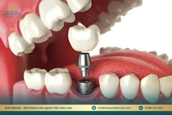 ghép xương tự thân cho bệnh nhân mất răng lâu năm
