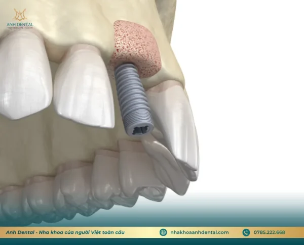 lợi ích của ghép xương tự thân trong implant về tương thích sinh học
