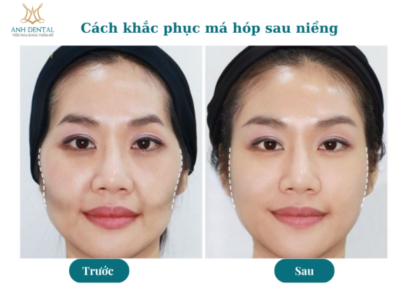 niềng răng bị hóp má có sao không