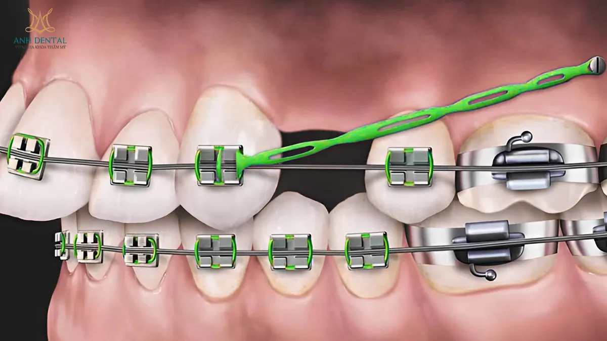 niềng răng bị hóp thái dương