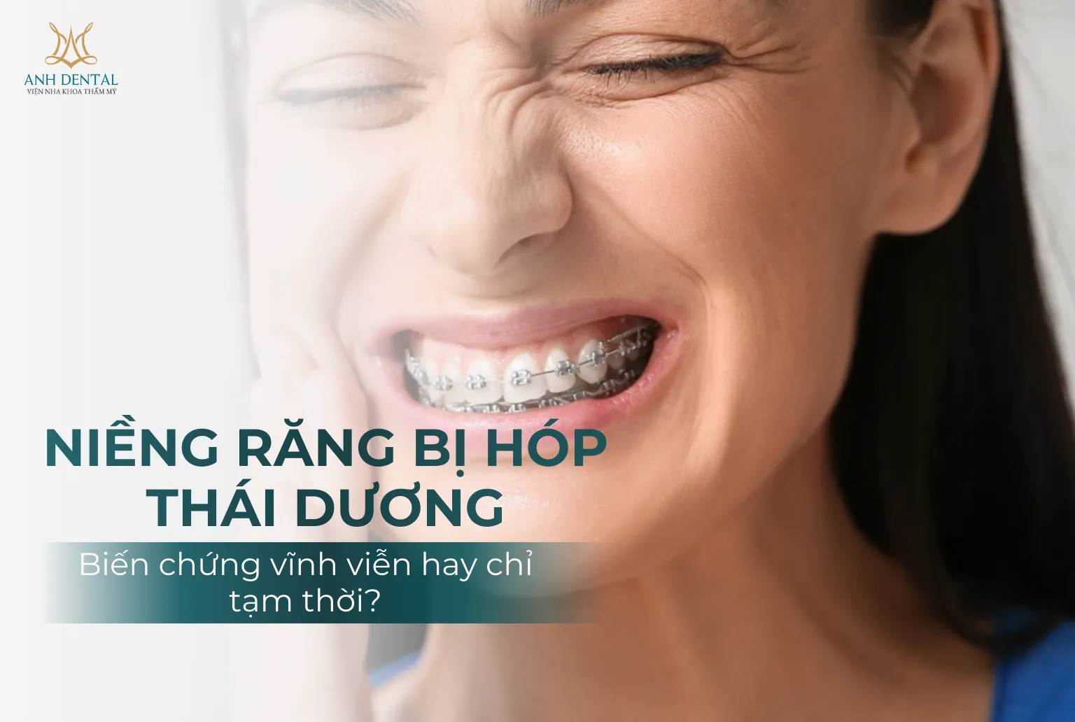 niềng răng bị hóp thái dương