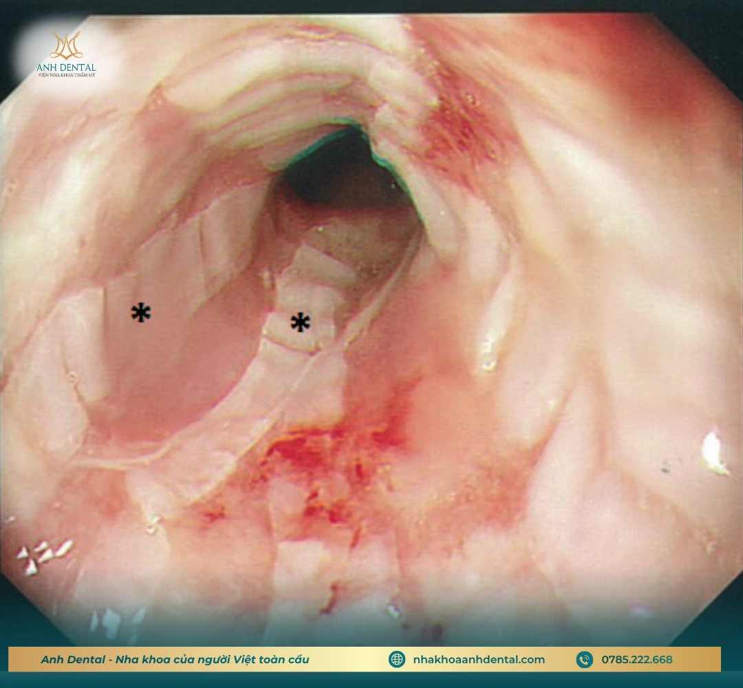 ghép xương tự thân trước khi cấy implant