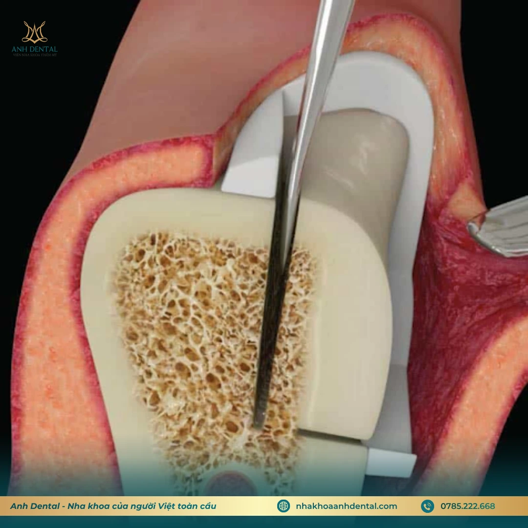 quy trình ghép xương tự thân trong implant