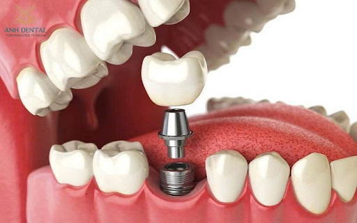 lợi ích của ghép xương tự thân