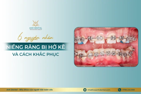 niềng răng bị hở kẽ