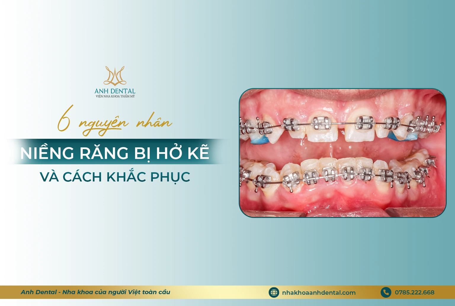 niềng răng bị hở kẽ