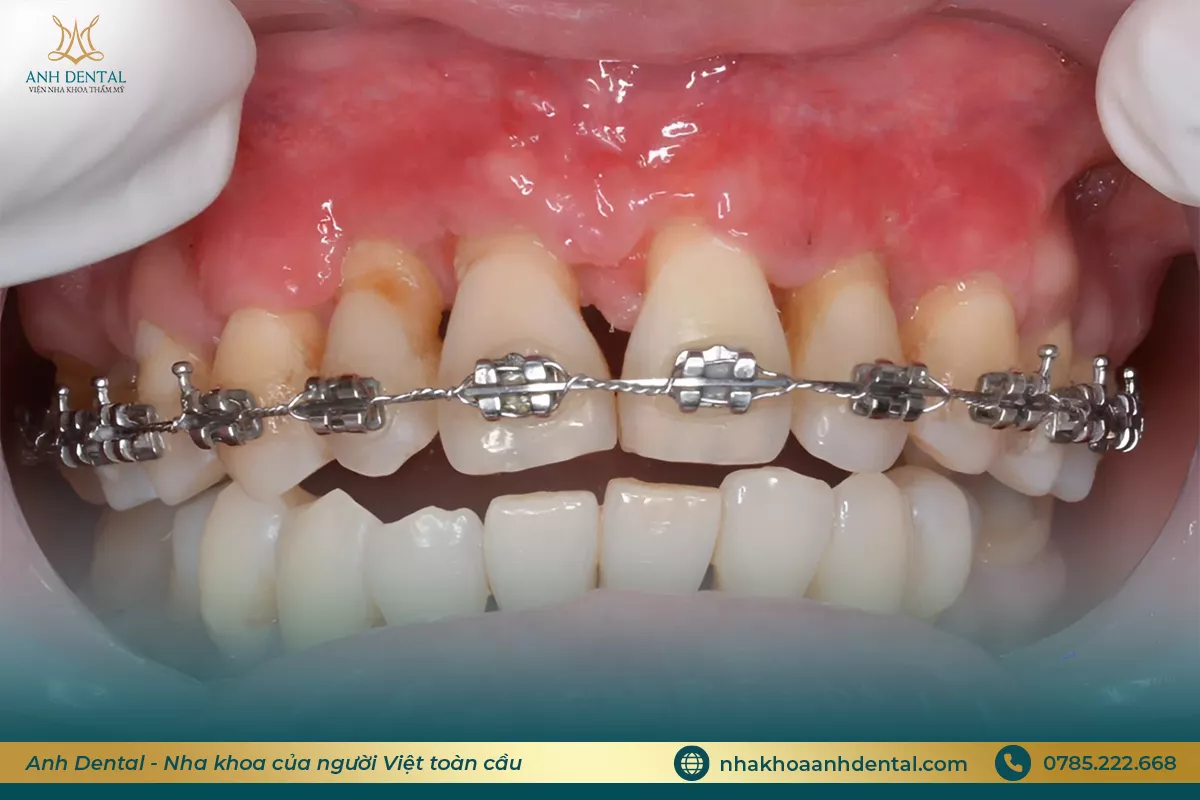 niềng răng bị lung lay