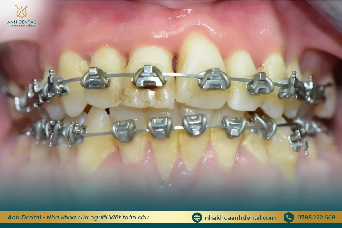 niềng răng bị lung lay