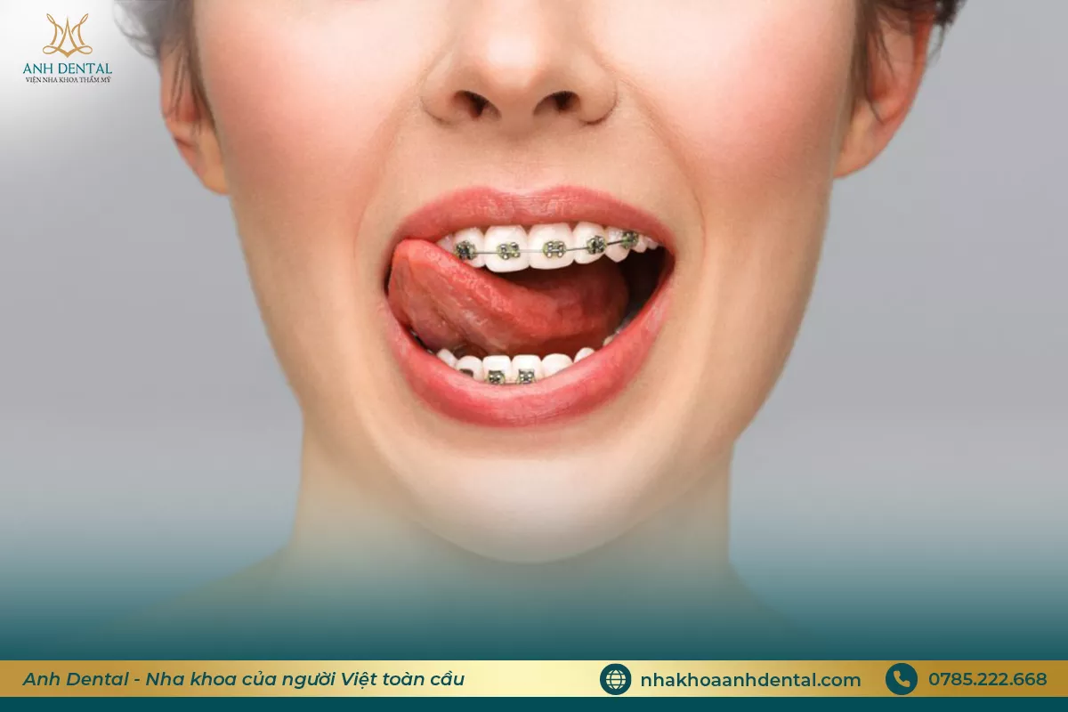 niềng răng bị lung lay