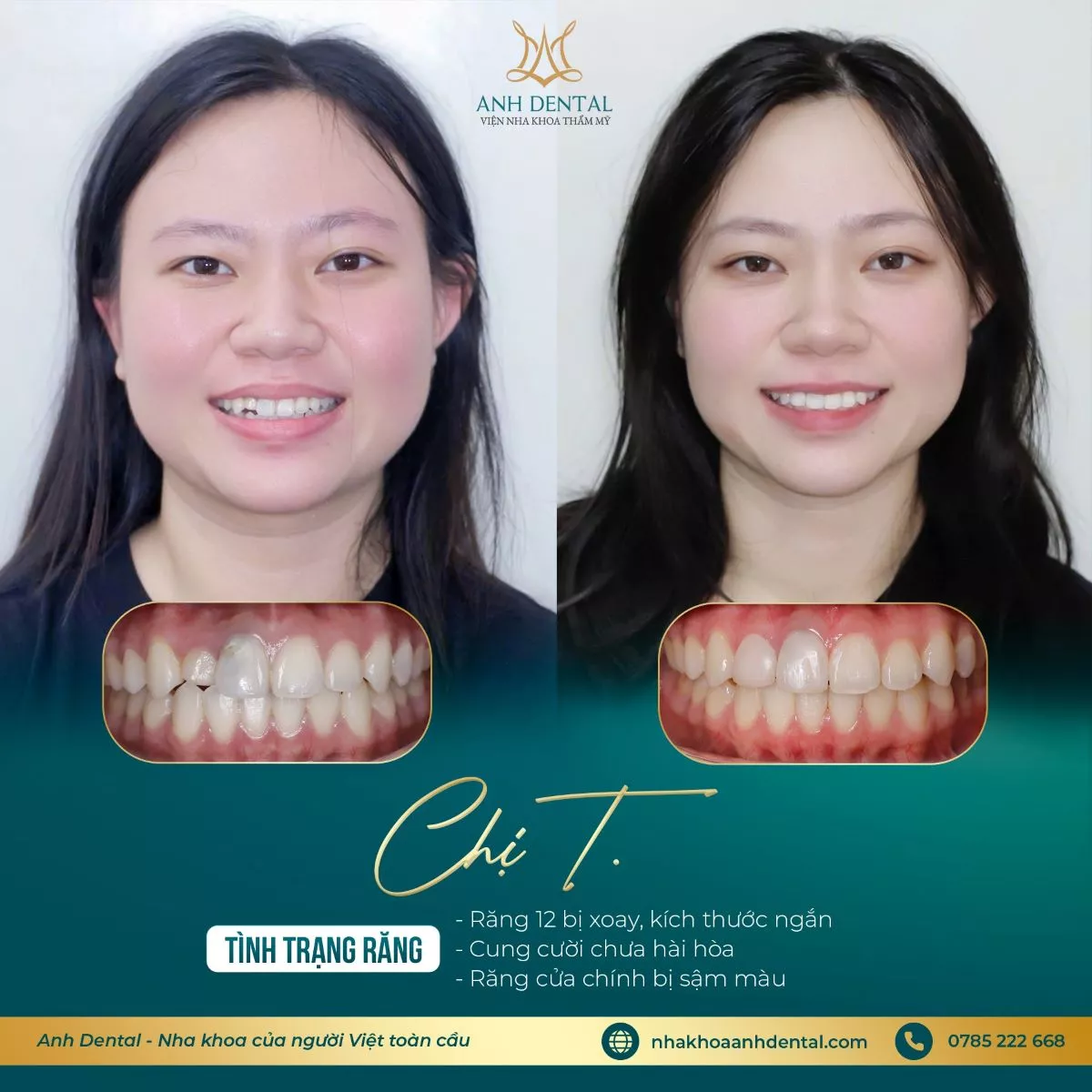 niềng răng bị lung lay