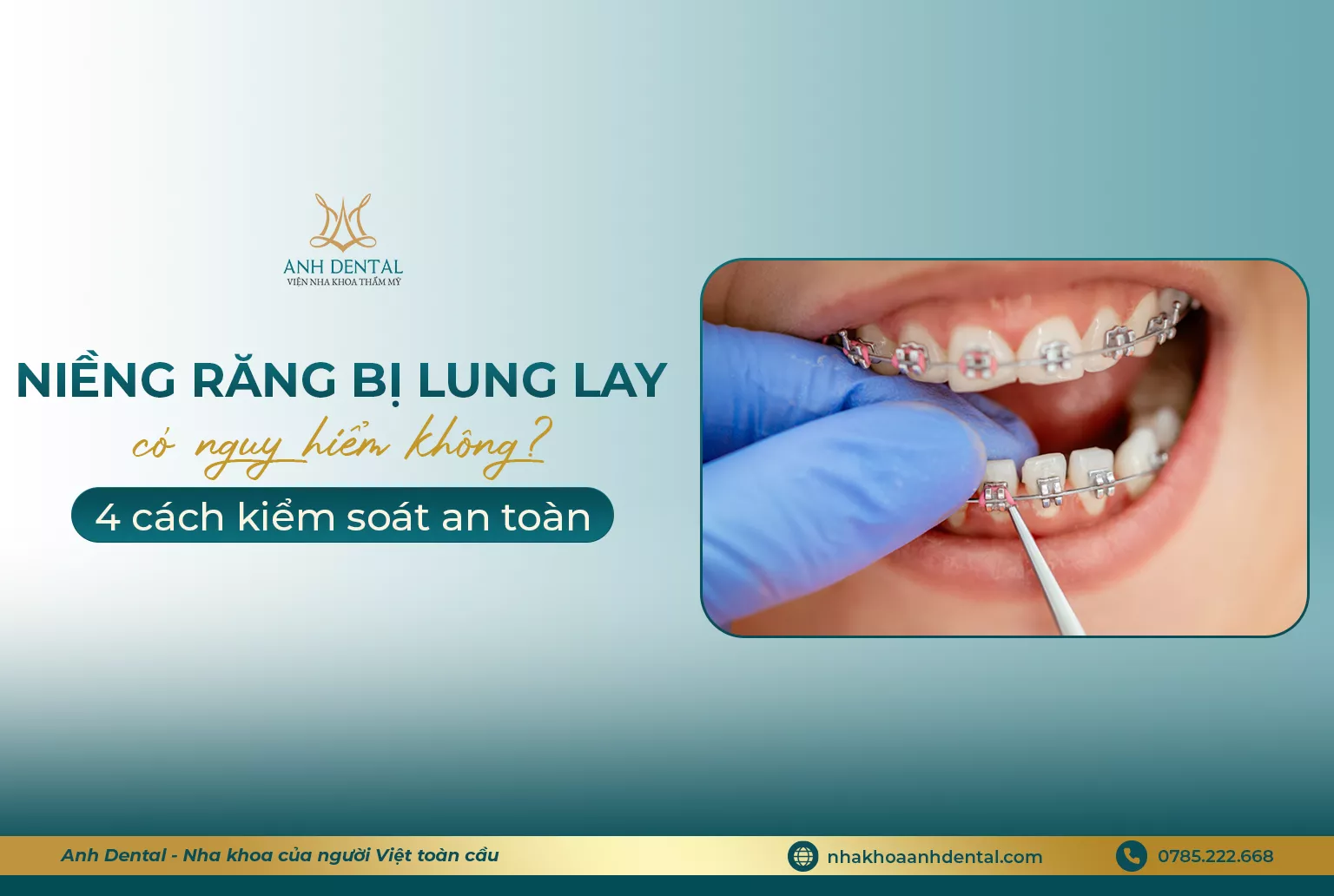 niềng răng bị lung lay