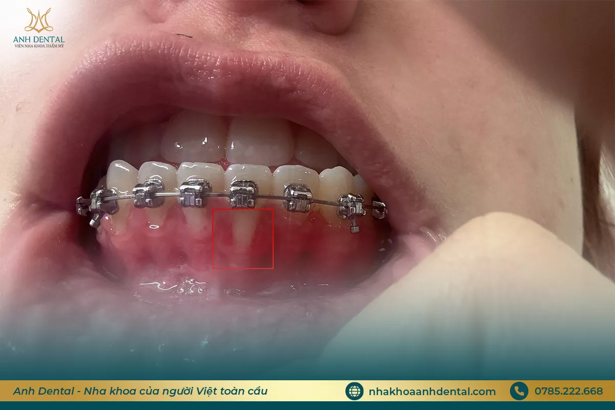 niềng răng bị tụt lợi