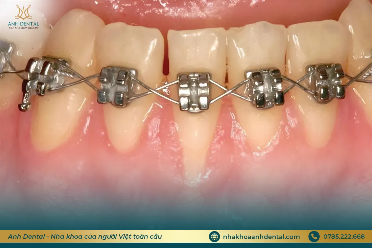 niềng răng bị tụt lợi