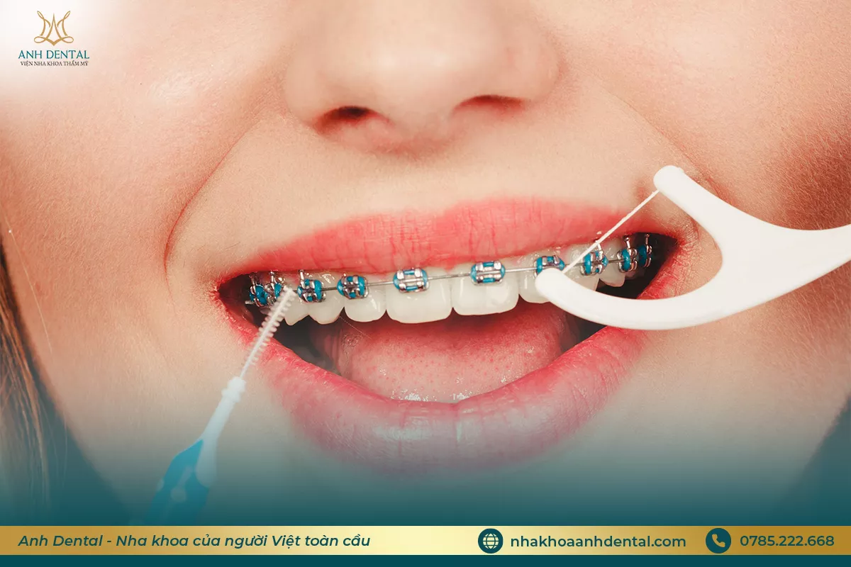 niềng răng bị tụt lợi