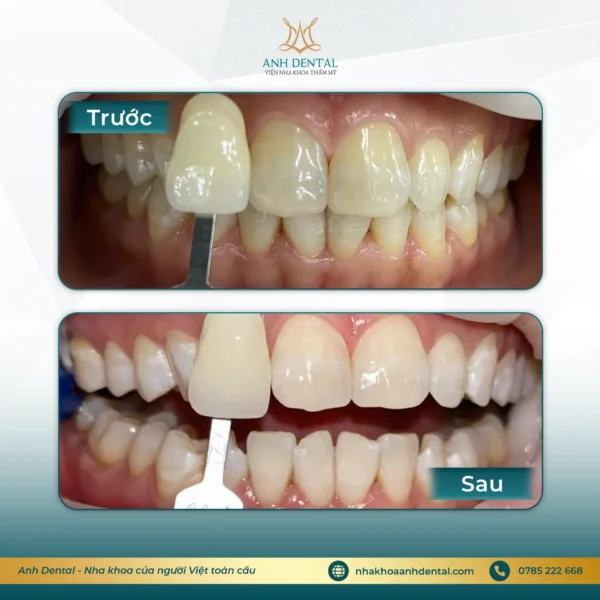 ưu đãi 8/3 tẩy trắng răng