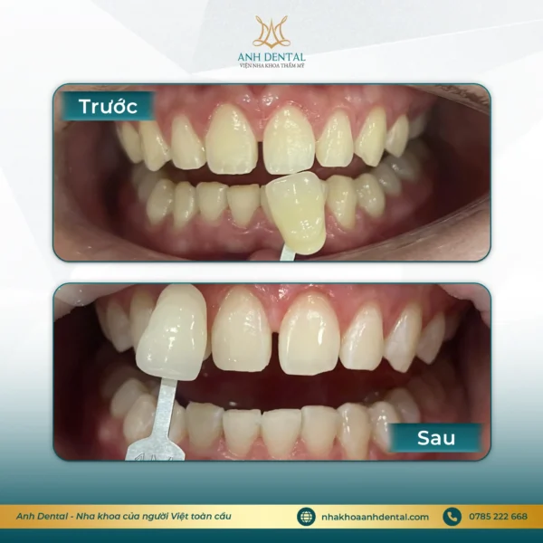 ưu đãi 8/3 tẩy trắng răng