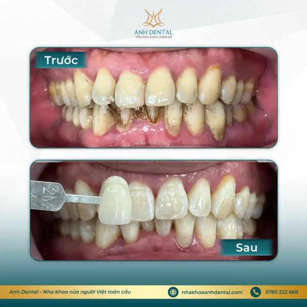 ưu đãi 8/3 tẩy trắng răng