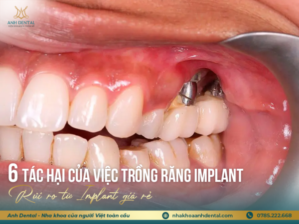 tác hại của việc trồng răng implant