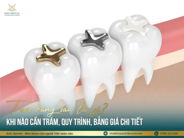 trám răng sâu