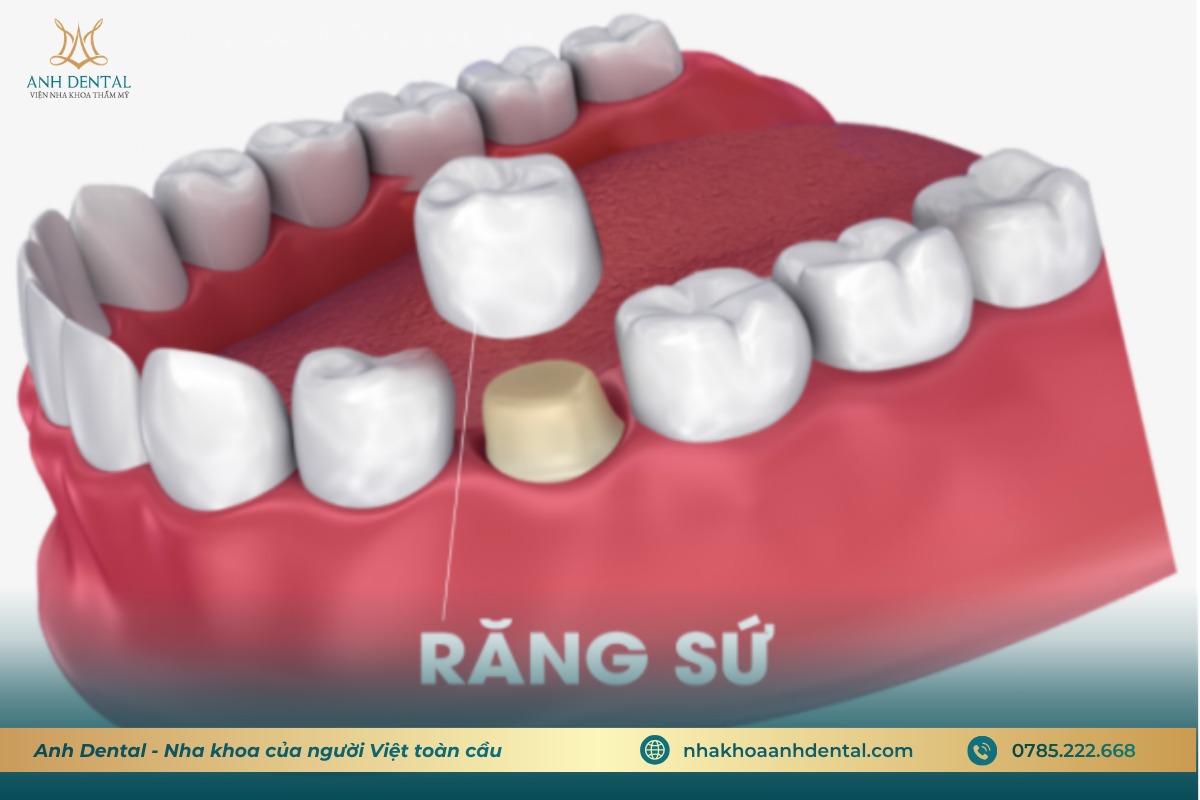 Bọc răng sứ cải thiện nụ cười