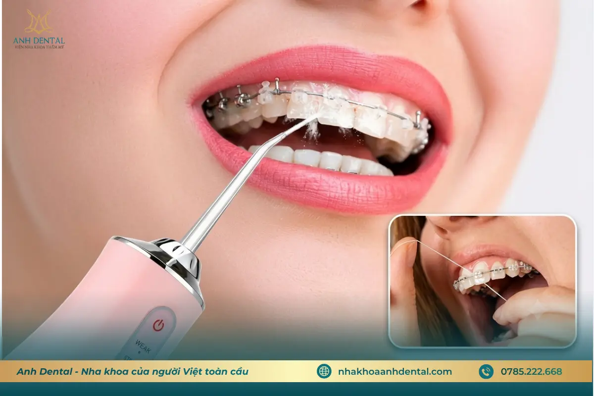 Vệ sinh răng miệng khi niềng răng