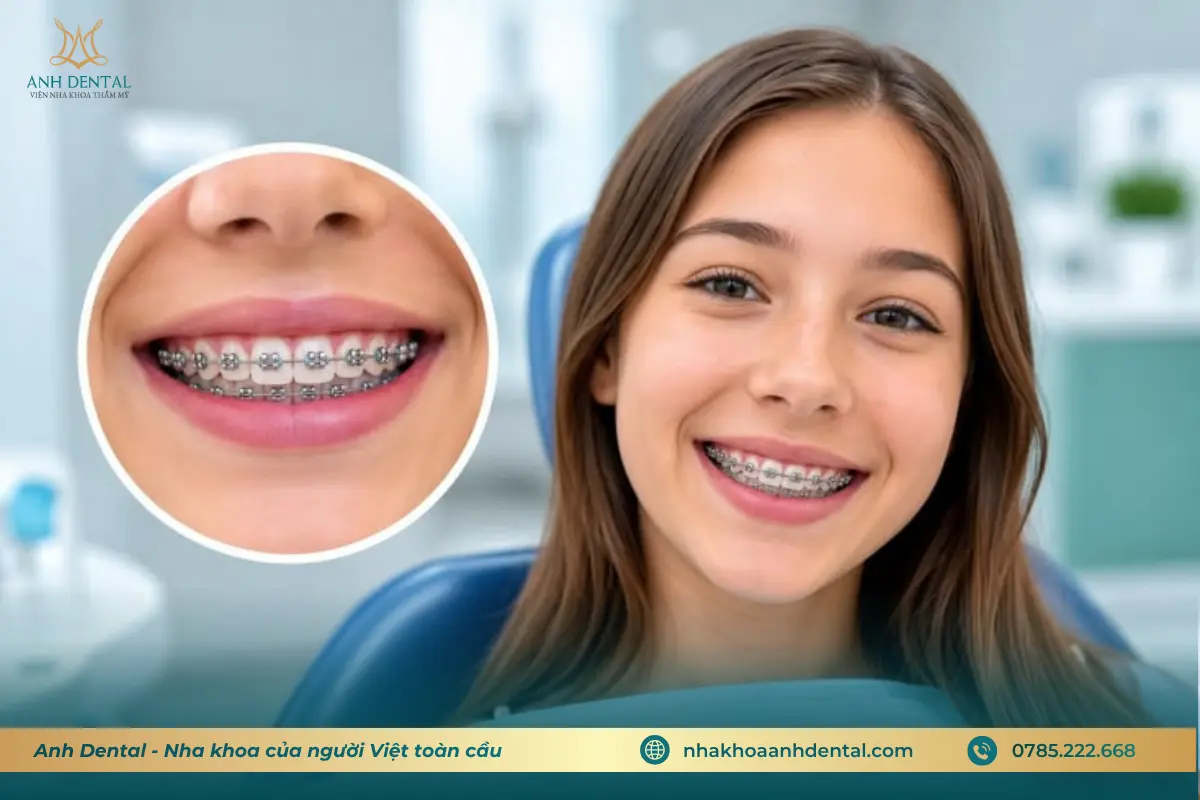 niềng răng bị yếu