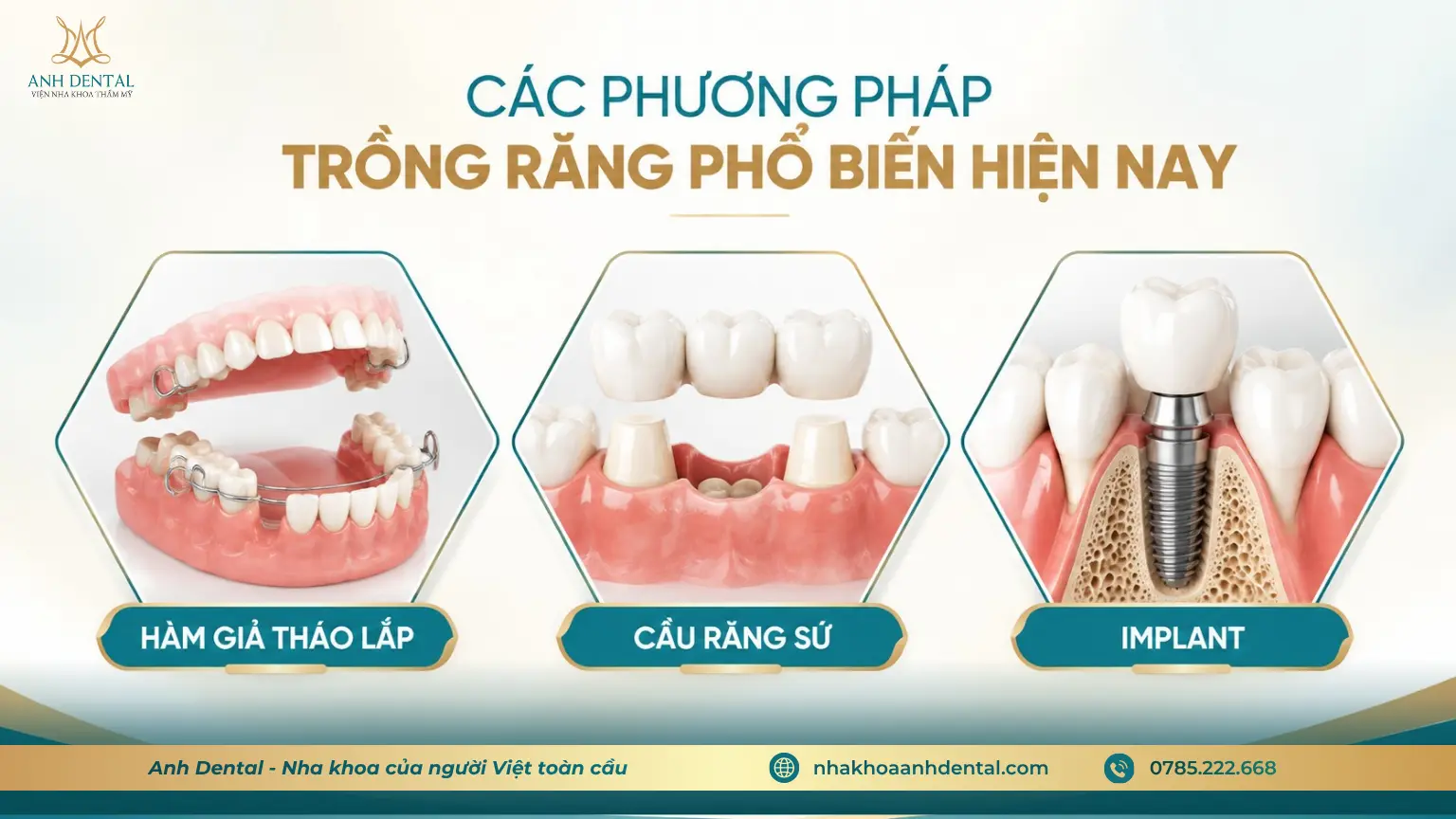 Các phương pháp trồng răng phổ biến hiện nay