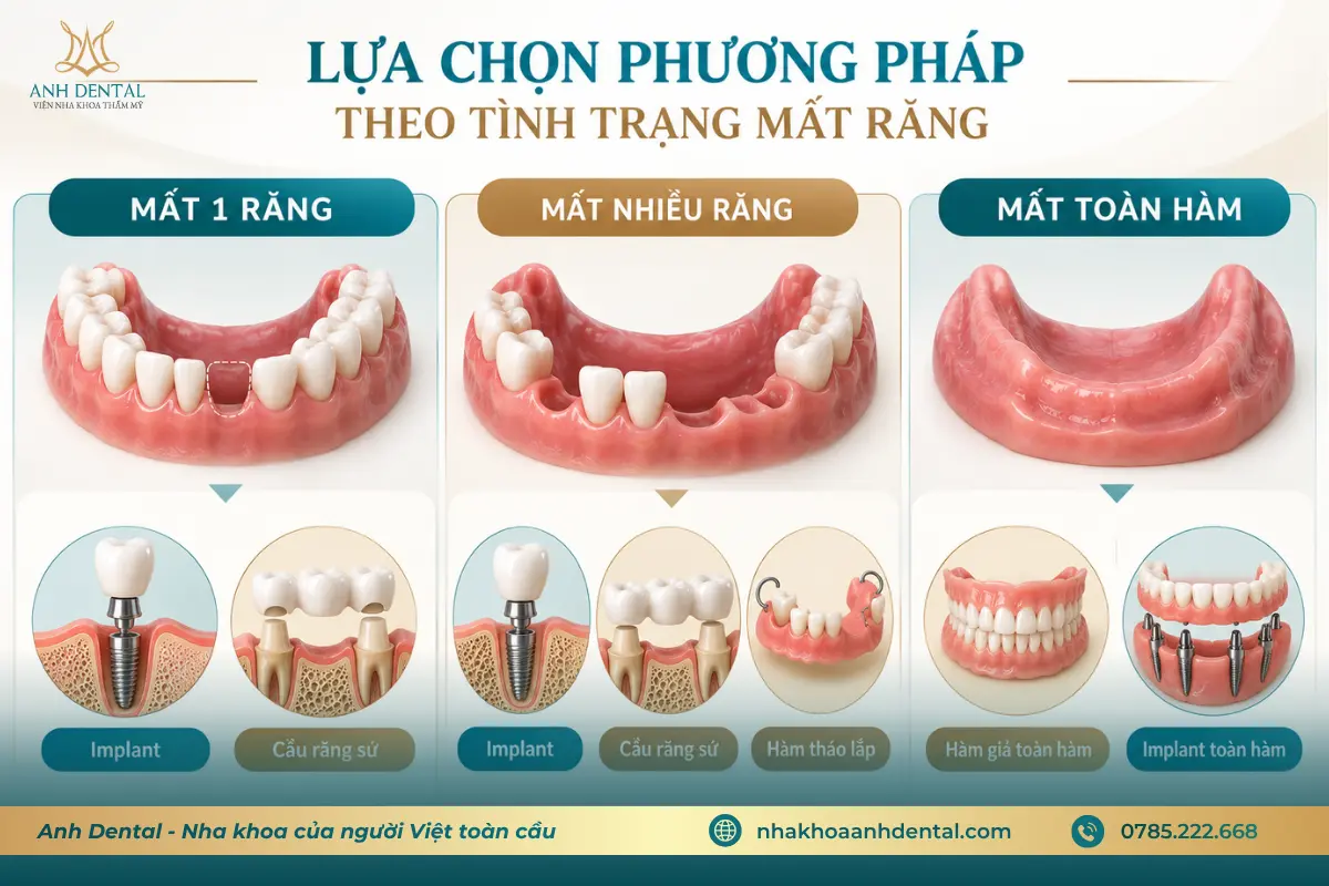 Lựa chọn phương pháp trồng răng phù hợp