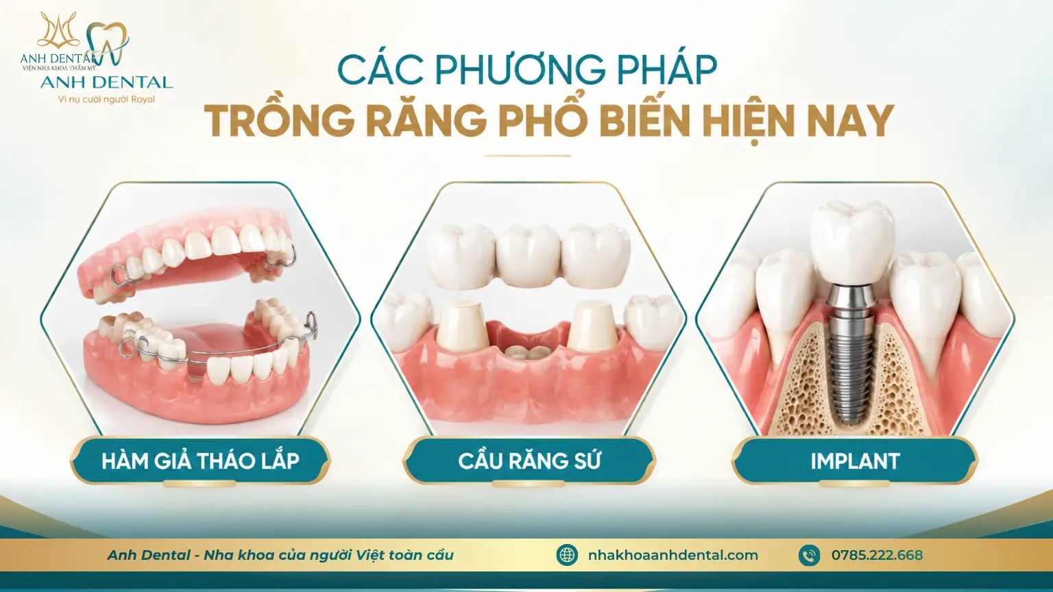 các phương pháp trồng răng phổ biến