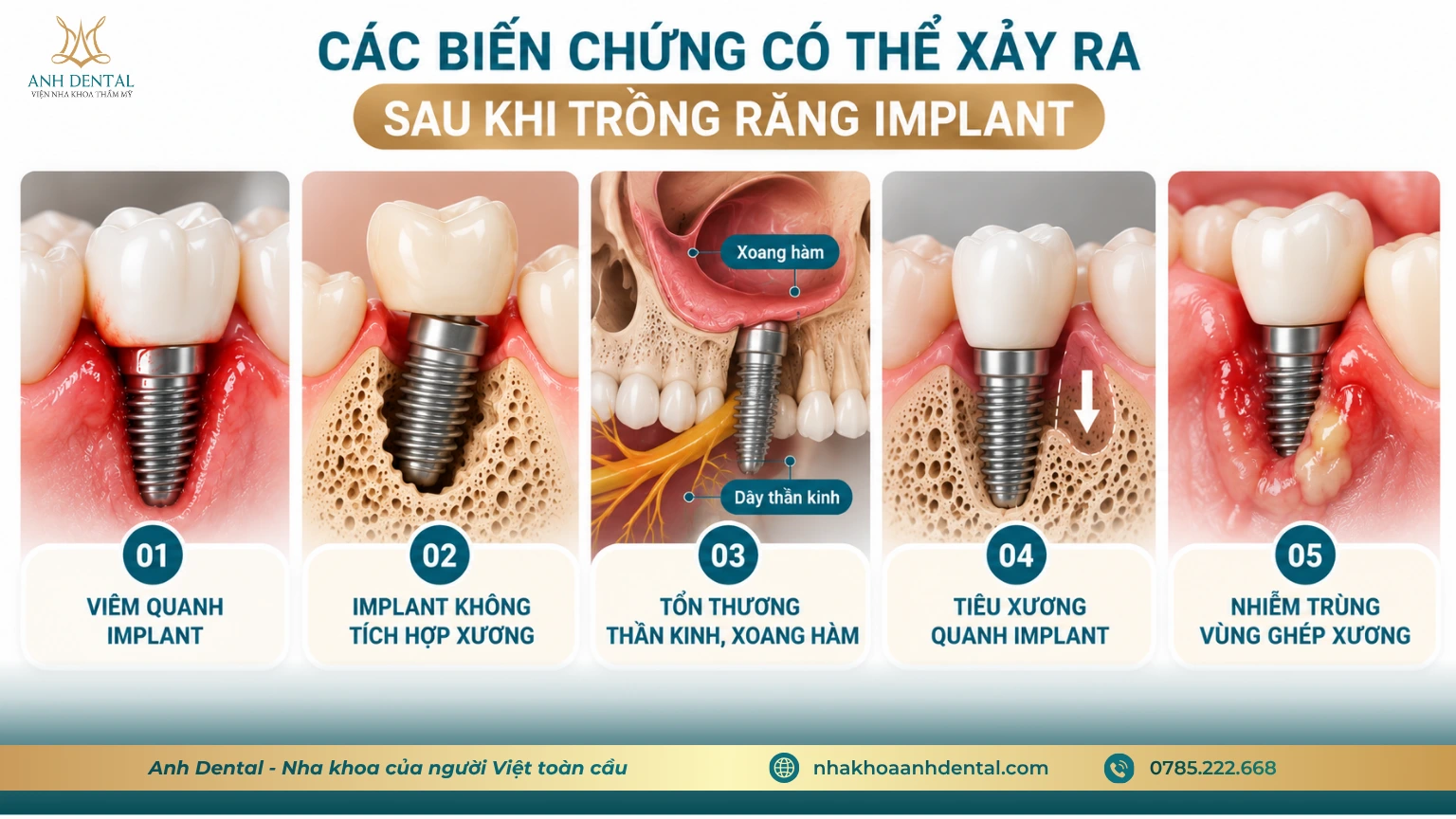 tác hại của việc trồng răng implant