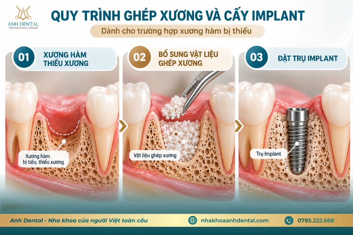 ghép xương răng trước khi cấy implant