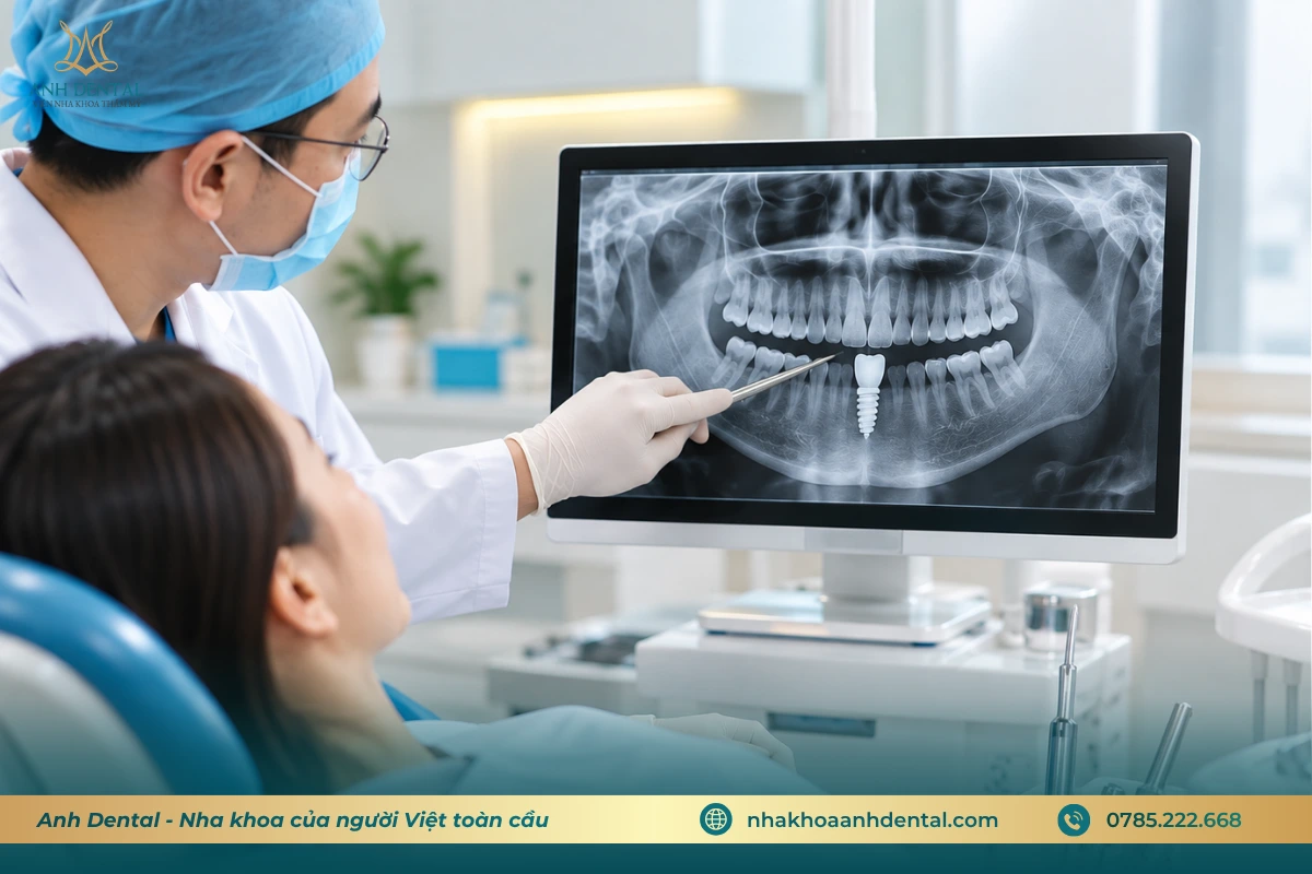 Thời gian hồi phục sau khi cấy Implant