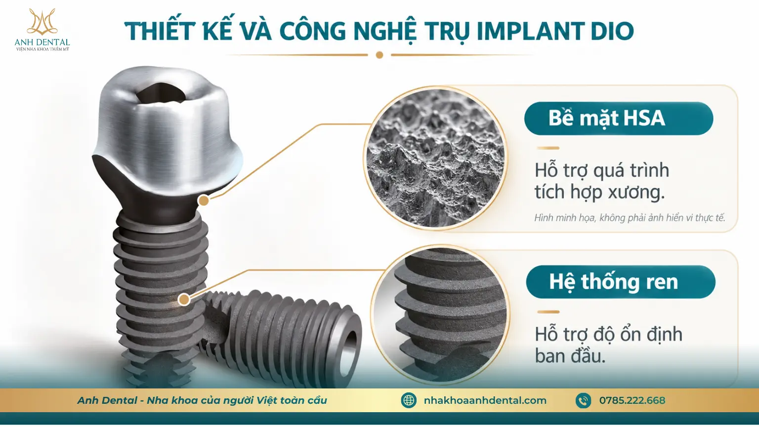 trụ implant Hàn Quốc