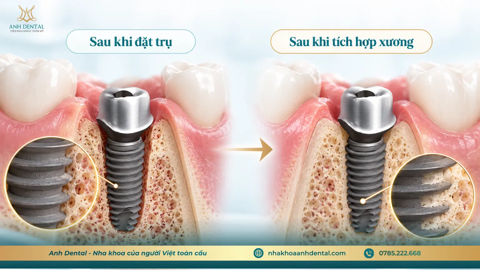 Khả năng tích hợp xương của trụ Implant Hàn Quốc Dio