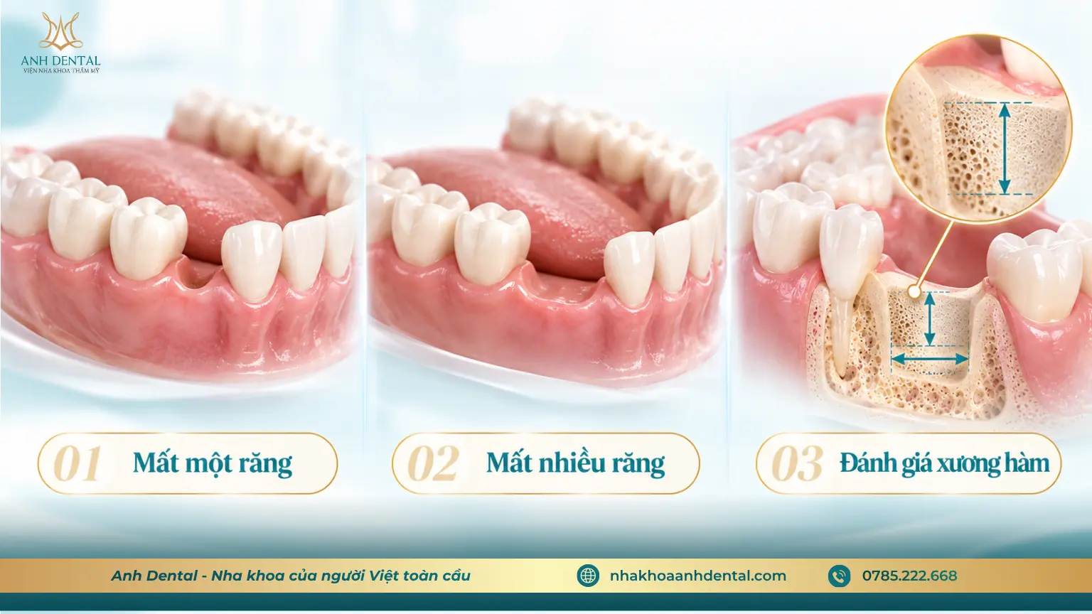 cân nhắc sử dụng trụ Implant Hàn Quốc Dio
